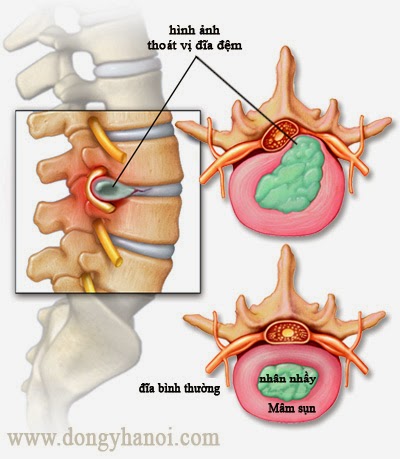 Tập xà đơn chữa thoát vị đĩa đệm