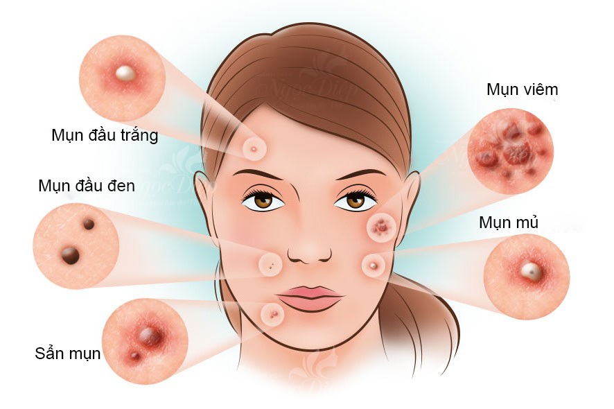 Bạn đã biết loại kem trị mụn hiệu quả nhất hiện nay?2