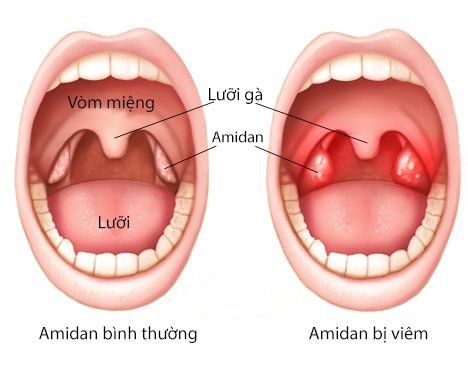 Bạn đã hiểu hết về bệnh viêm họng cấp chưa?2