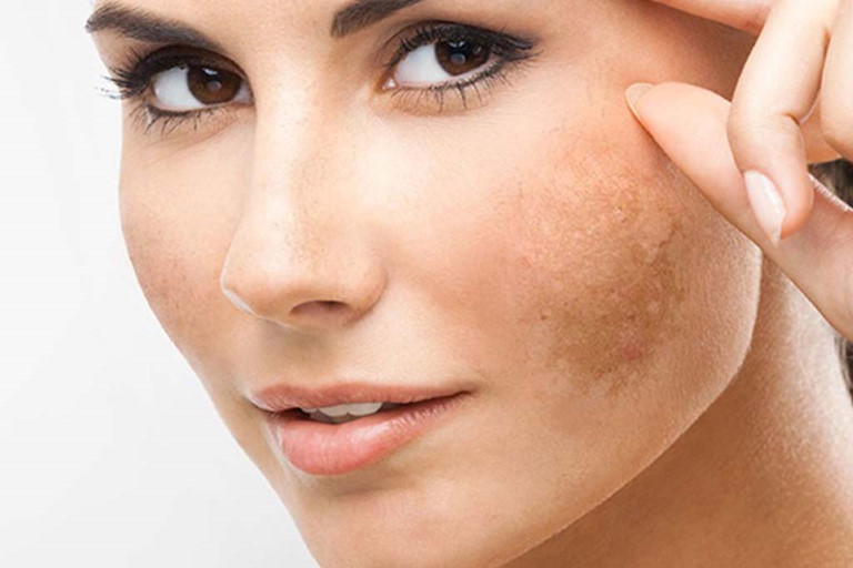 Bí quyết phòng nám da không nên bỏ qua cho phái đẹp?5