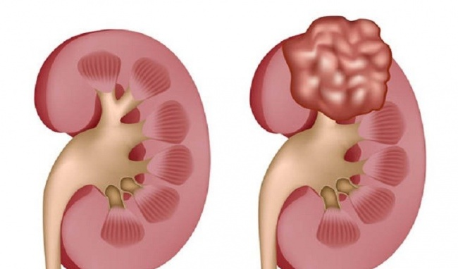 Cách phân biệt thận đa nang và nang thận 