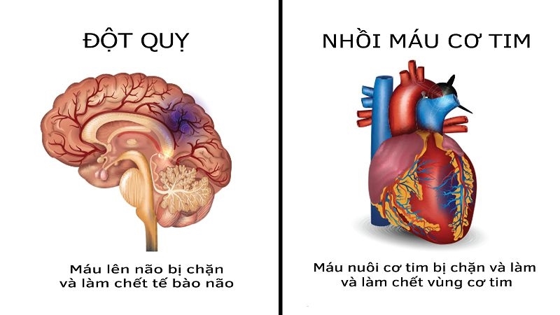 Căn bệnh thầm lặng chết người – Nhồi máu cơ tim