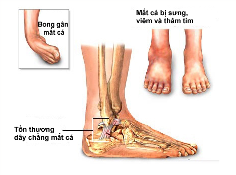 chấn thương thường gặp khi chạy bộ