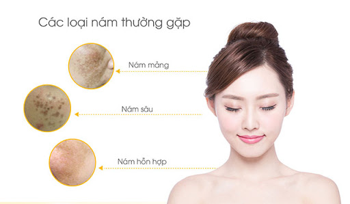 Chớ coi thường nám và tan nhang ở tuổi 25?3