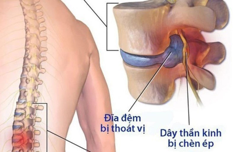 dai-lưng-ho-tro-thoat-vi-dia-dem-hieu-qua-an-toan