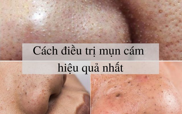 Đôi điều về mụn cám và cách điều trị hiệu quả?