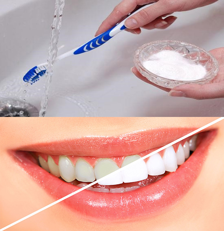 Giải pháp giúp bạn có hàm răng trắng sáng?