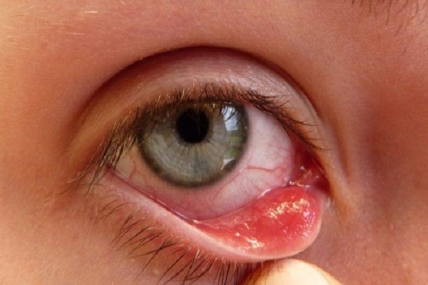 Giúp bạn hiểu hơn về bệnh đau mắt hột?1