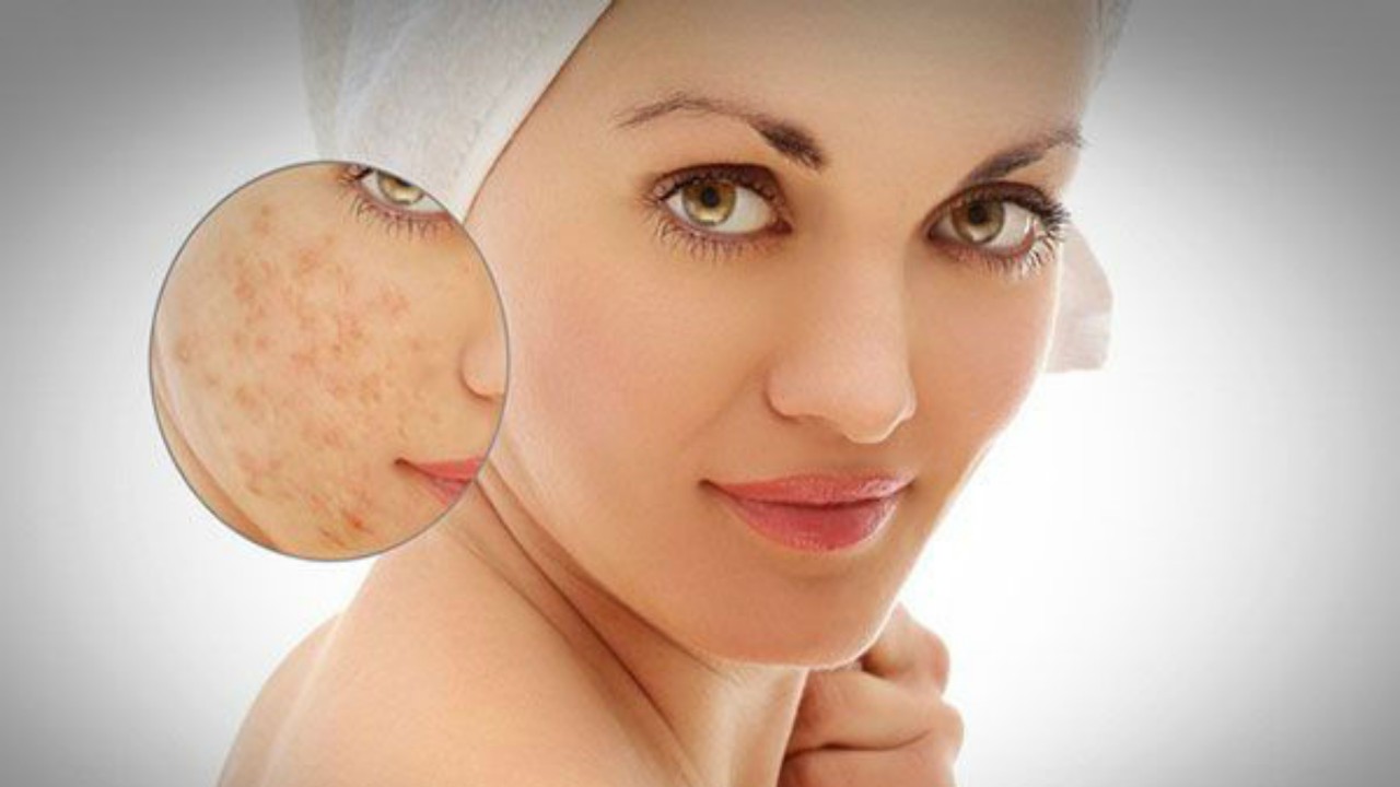 Làn da bị sẹo và thâm mụn sẽ ảnh hưởng thế nào tới bạn?6