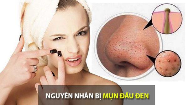 Mụn đầu đen và cách điều trị không thể bỏ qua?2