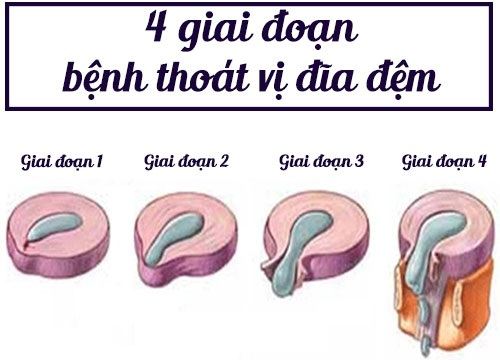 Người bị thoát vị đĩa đệm được bác sĩ khuyến cáo nên sử dụng ghế massage hàng ngày. Tuy nhiên, lựa chọn ghế massage cho người bị thoát vị đĩa đệm nên chú ý tới những yếu tố nào?