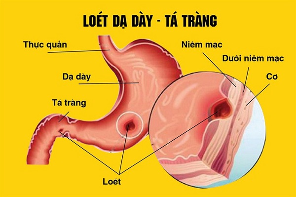 Nguyên nhân bệnh viêm dạ dày – tá tràng?