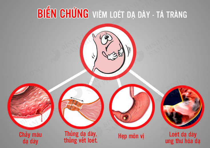 Nguyên nhân bệnh viêm dạ dày – tá tràng?2