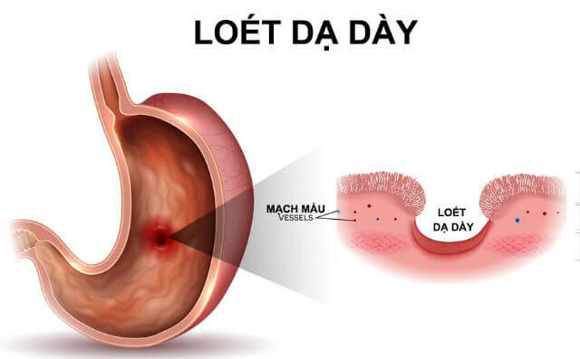 Nguyên nhân bệnh viêm dạ dày – tá tràng?3