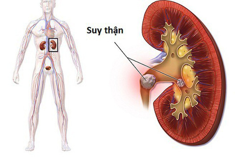 Những dấu hiệu của bệnh thận và suy thận?2