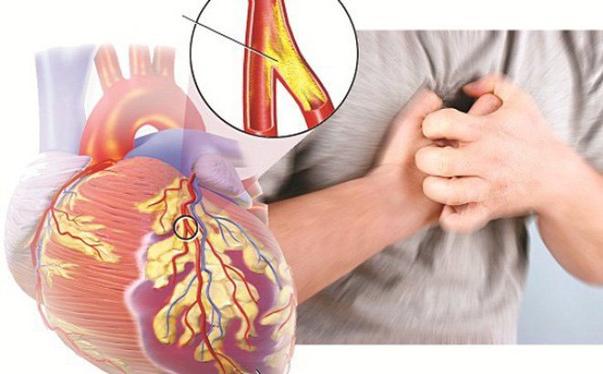 Review bệnh thiếu máu cơ tim có nguy hiểm không?2