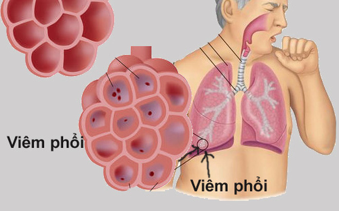 Review dấu hiệu bệnh viêm phổi ở trẻ?