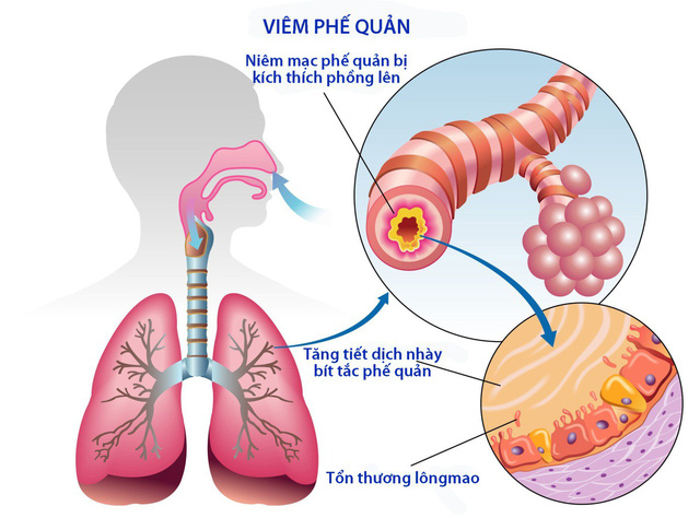 Review về bệnh viêm phế quản cấp?1