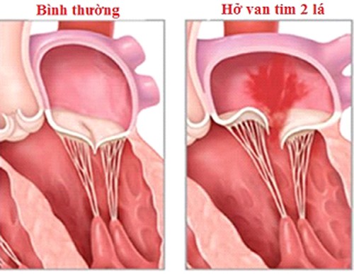 Review về câu hỏi hở van tim có nguy hiểm?2