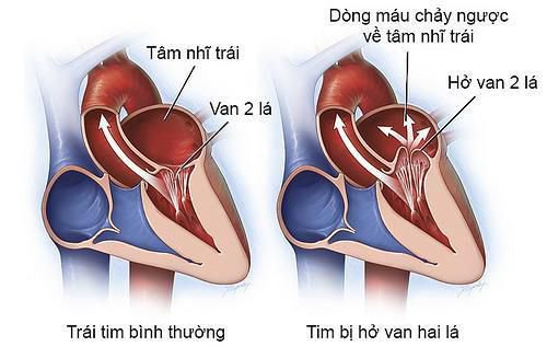 Review về câu hỏi hở van tim có nguy hiểm?