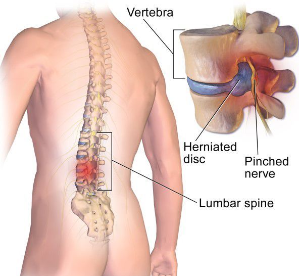 toát vị đĩa đệm