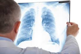 Top những điều cần biết về bệnh lao màng phổi?