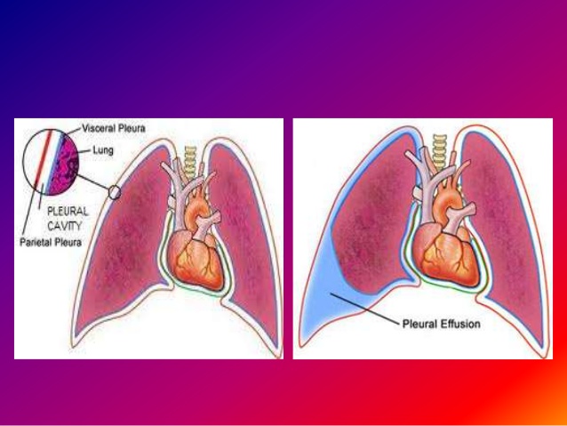 Top những điều cần biết về bệnh lao màng phổi?2