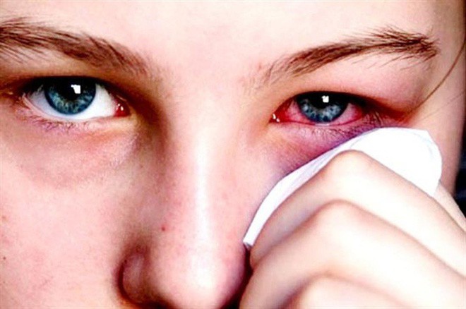 Top những nguyên nhân gây bệnh đau mắt đỏ?