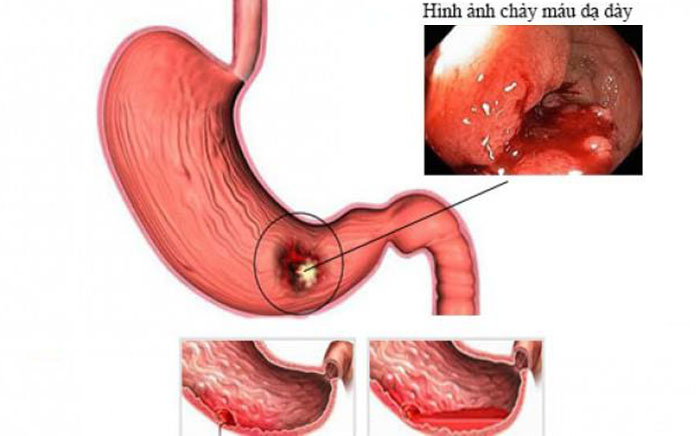 Top những thủ phạm gây bệnh xuất huyết dạ dày?