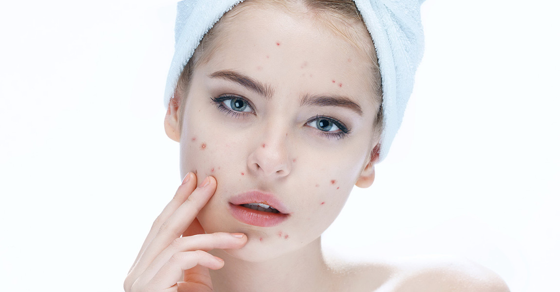 Trị mụn trứng cá ở tuổi dậy thì đúng cách?5