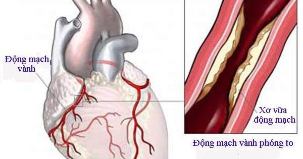 benh-dong-mach-vanh-va-cac-yeu-to-nguy-co-khi-chay-bo-1