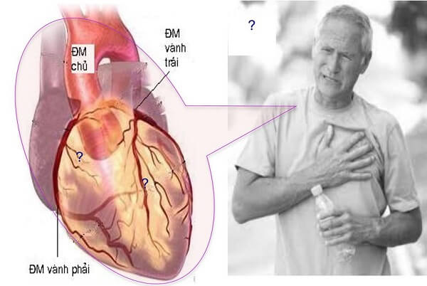 benh-dong-mach-vanh-va-cac-yeu-to-nguy-co-khi-chay-bo-3