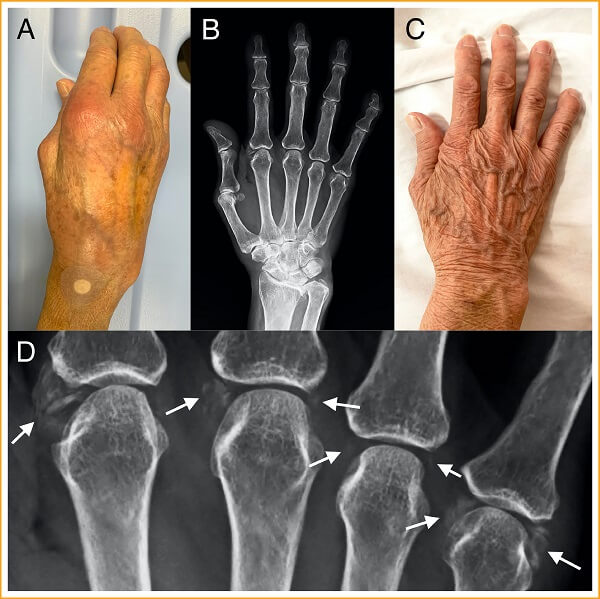 bi-quyet-giup-nguoi-viem-khop-dang-thap-nang-cao-chat-luong-song-2