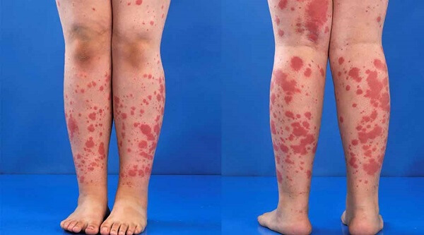 bi-quyet-giup-nguoi-viem-khop-dang-thap-nang-cao-chat-luong-song-3