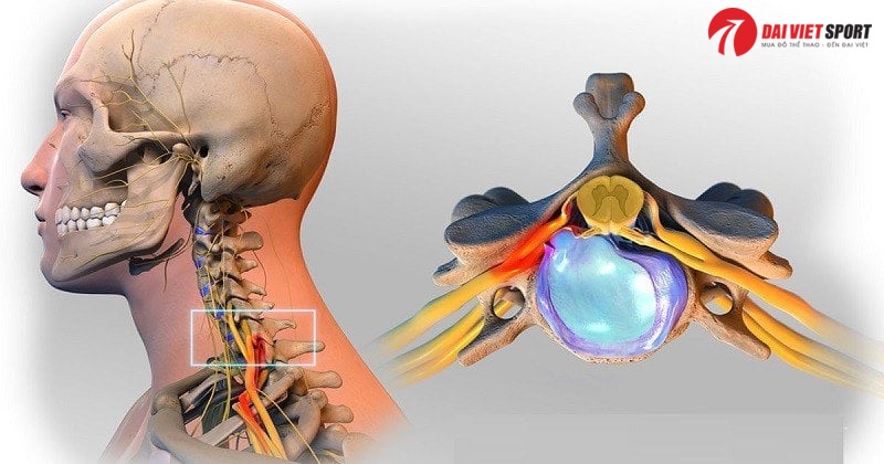 Cảnh giác chấn thương cổ, khuỷu tay khi tập thể hình