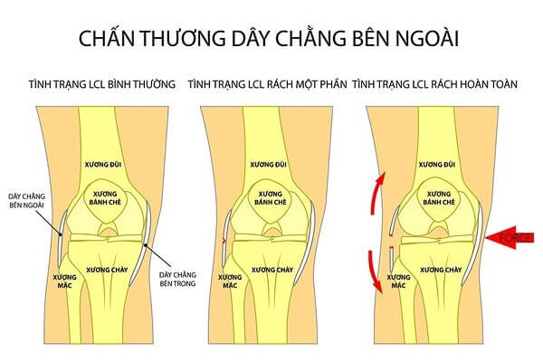 chan-thuong-day-chang-ben-ngoai