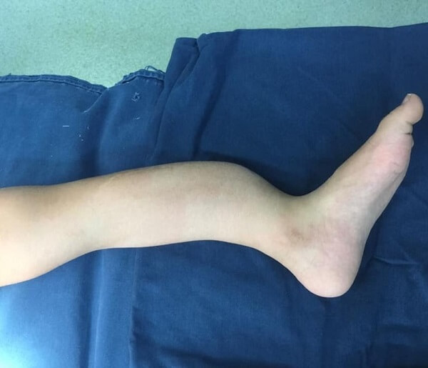 chay-bo-dung-cach-phong-tranh-chan-thuong-6