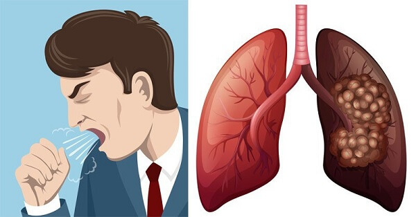 Hướng dẫn tập luyện phục hồi chức năng cho phổi