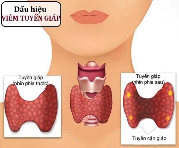 dau-hieu-viem-tuyen-giap