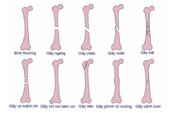 phan-loai-gay-xuong-2