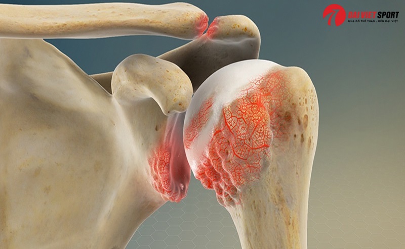 Thoái hóa đa khớp và dụng cụ tập phục hồi phù hợp