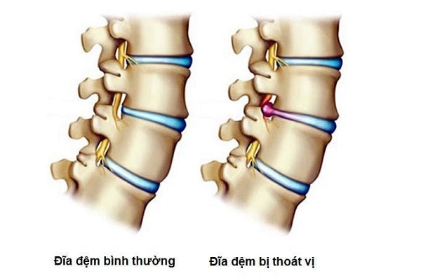 thoat-vi-dia-dem-la-gi