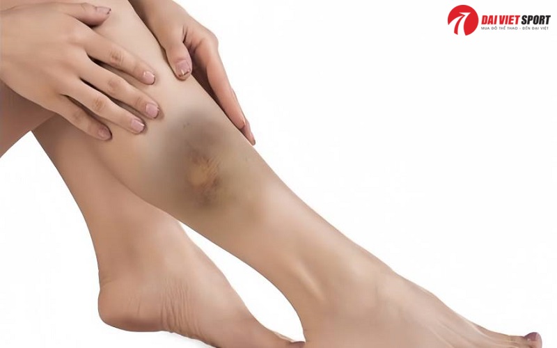 Thời gian phục hồi chấn thương mô mềm