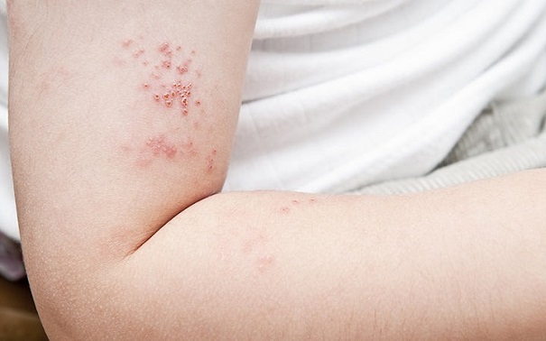 trieu-chung-nhiem-trung-mau-2