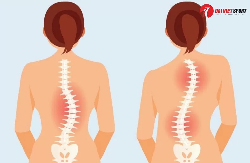 Vật lý trị liệu cong vẹo cột sống