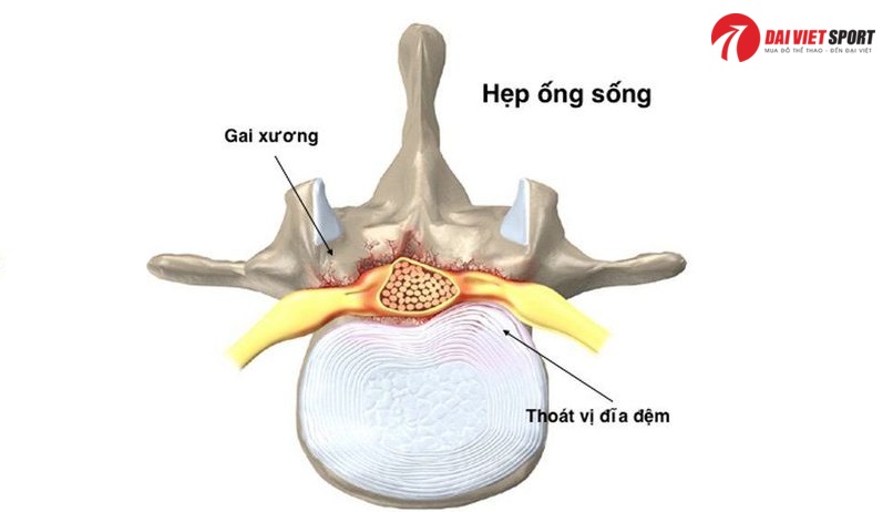 Vật lý trị liệu hẹp ống sống