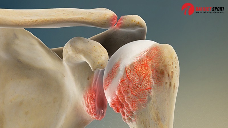 Vật lý trị liệu thoái hóa đa khớp