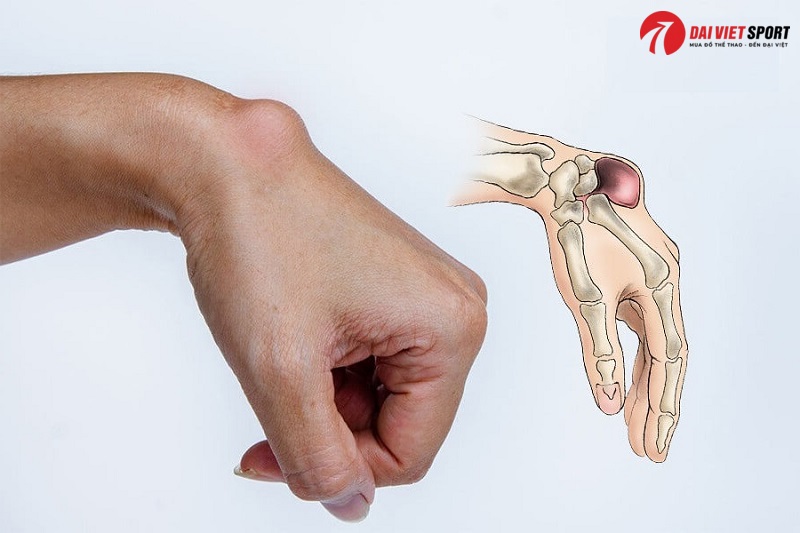 Vật lý trị liệu viêm bao hoạt dịch