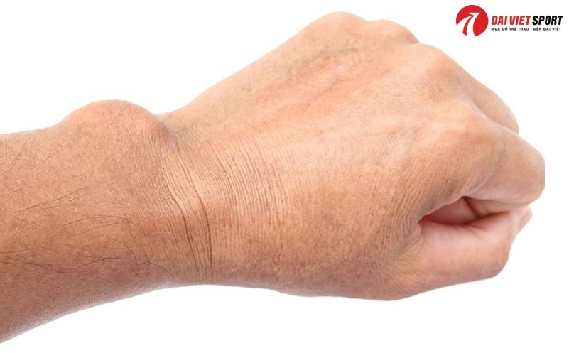 Viêm bao hoạt dịch và dụng cụ tập phục hồi phù hợp