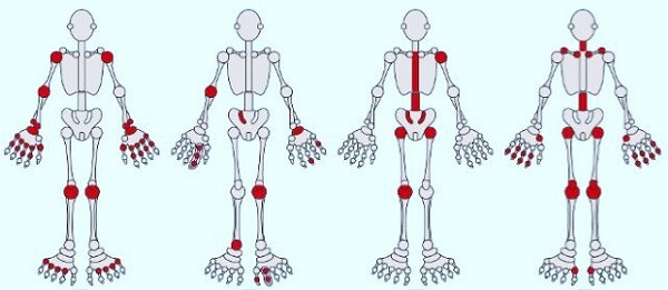 viem-khop-dang-thap-nguyen-nhan-trieu-chung-va-cach-dieu-tri-9